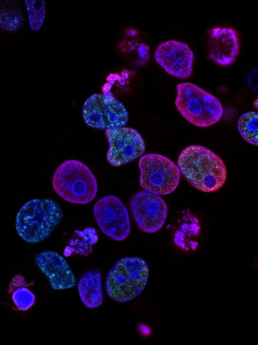 Cancer cells under the microscope